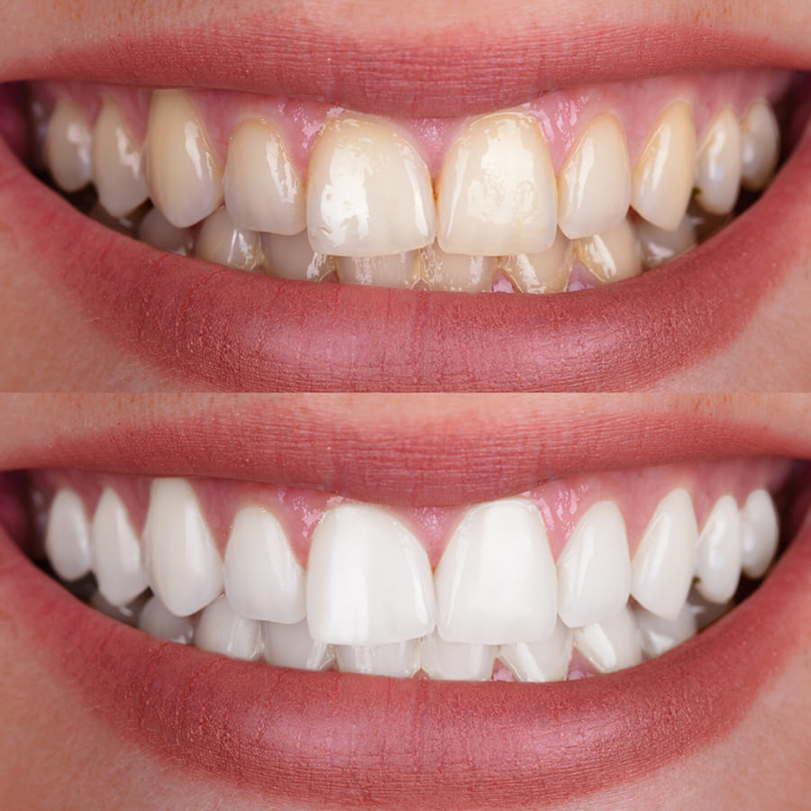 Clareamento Dental