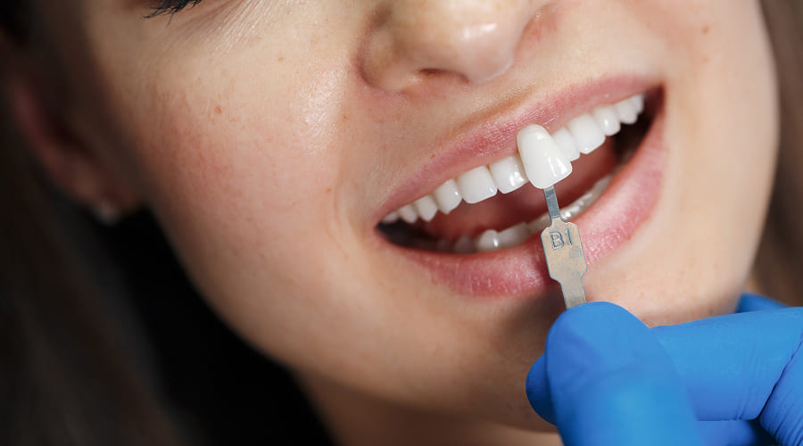 Clareamento Dental