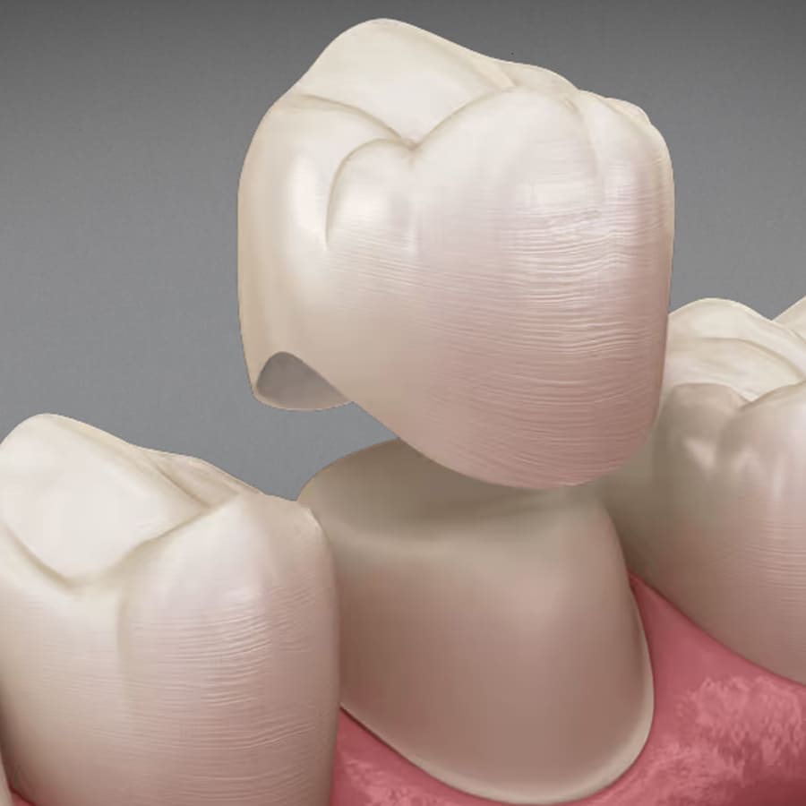 Coroa Dentária