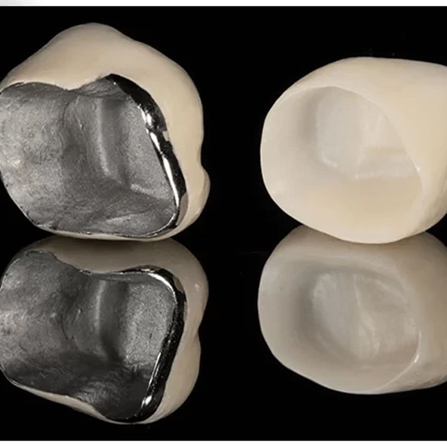 Coroa Dent ria Vai Devolver Um Sorriso Natural Para Voc stre