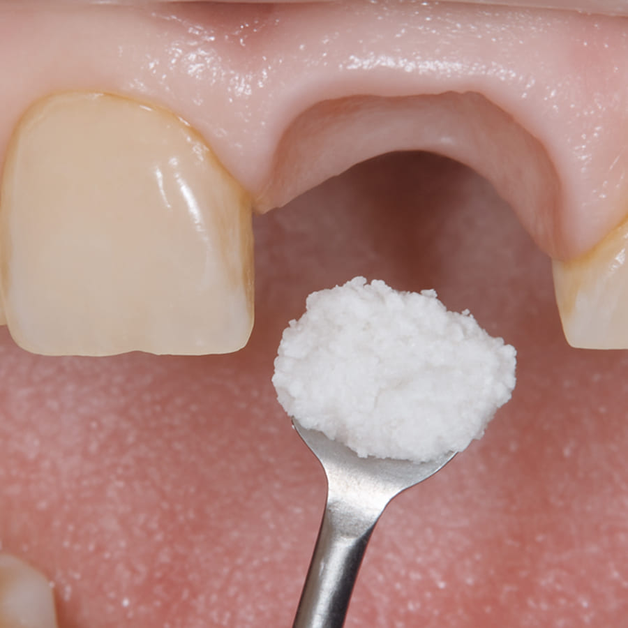 Enxerto Ósseo Odontológico