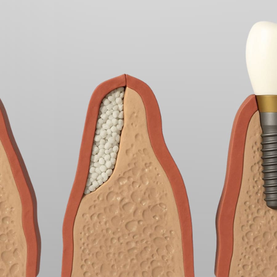 Enxerto Ósseo Odontológico