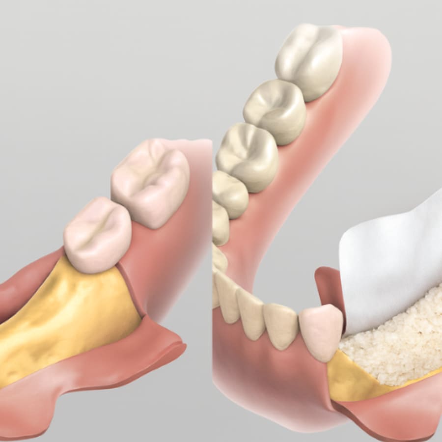 Enxerto Ósseo Odontológico