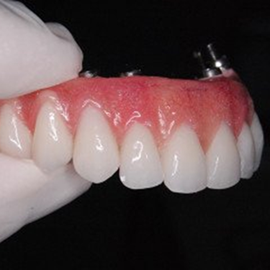Implante Dentário