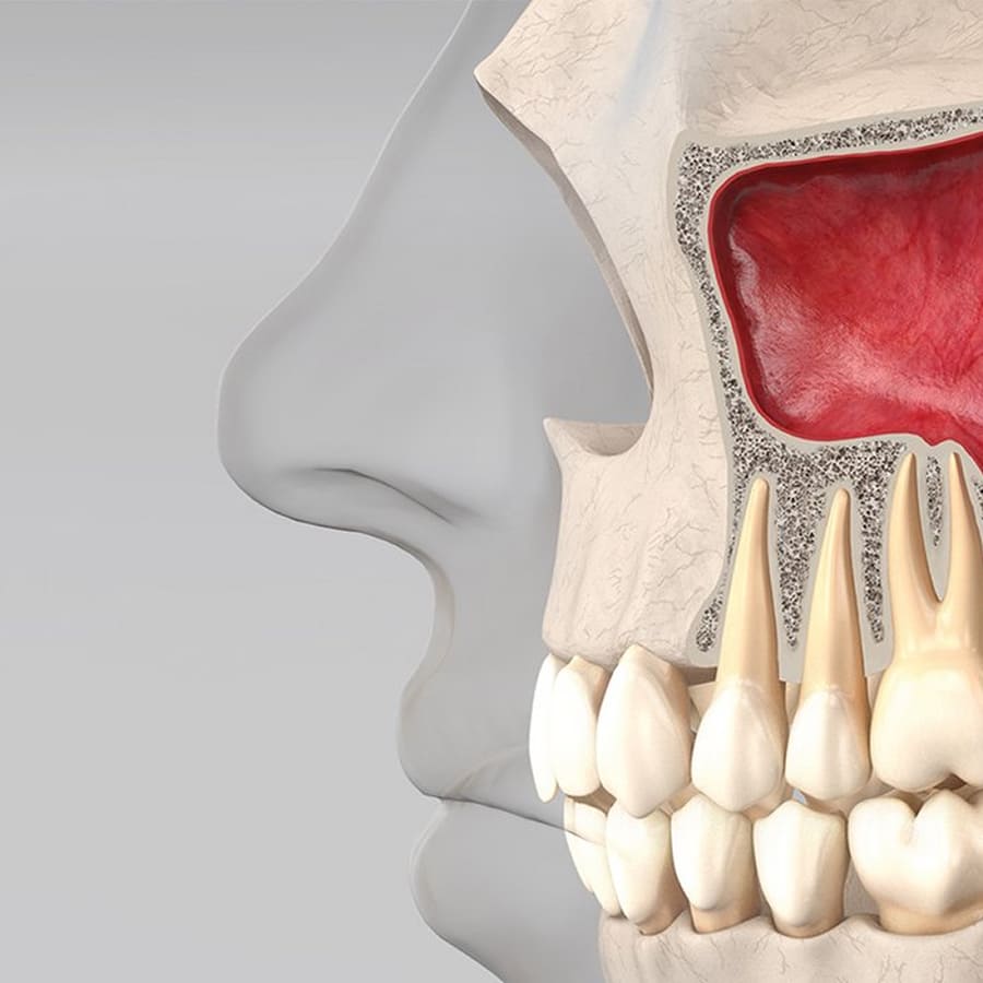 Levantamento de Seio Maxilar
