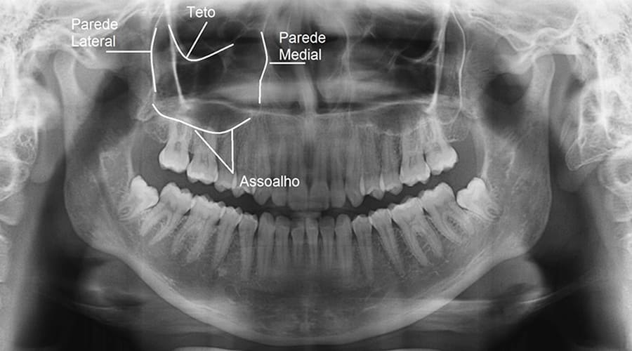 Levantamento de Seio Maxilar