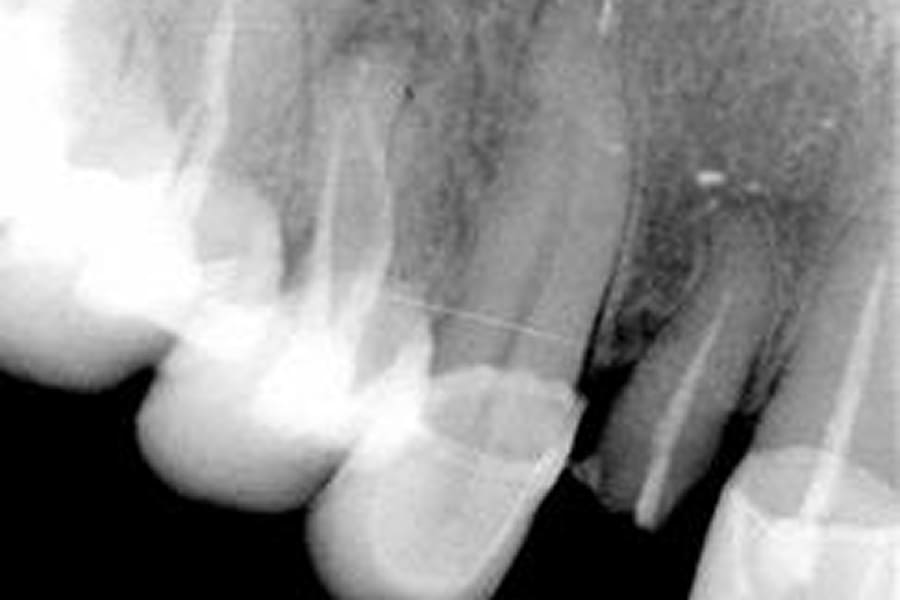 Extração de Raiz Dentária