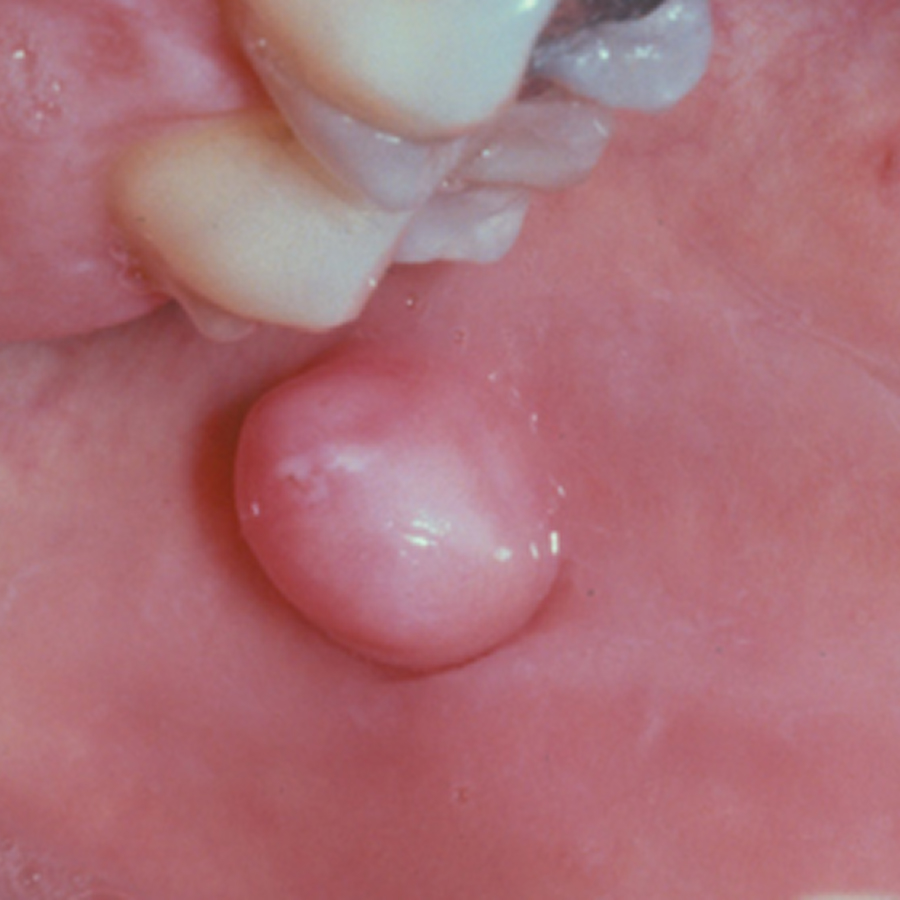 Remoção de Fibromas