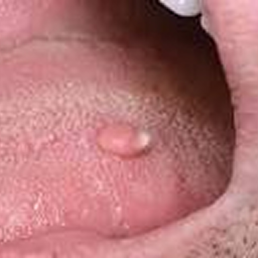 Remoção de Fibromas