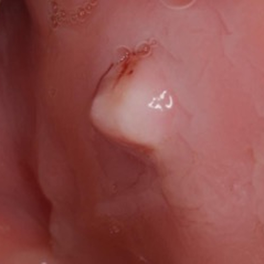 Remoção de Fibromas