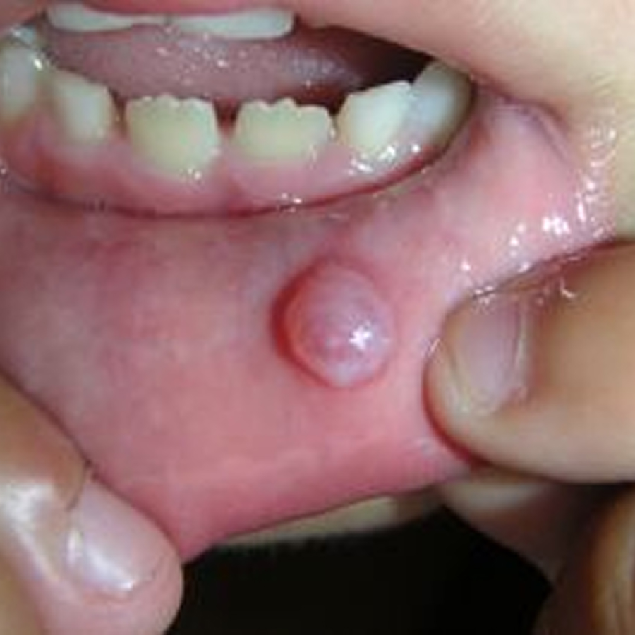 Remoção de Mucoceles