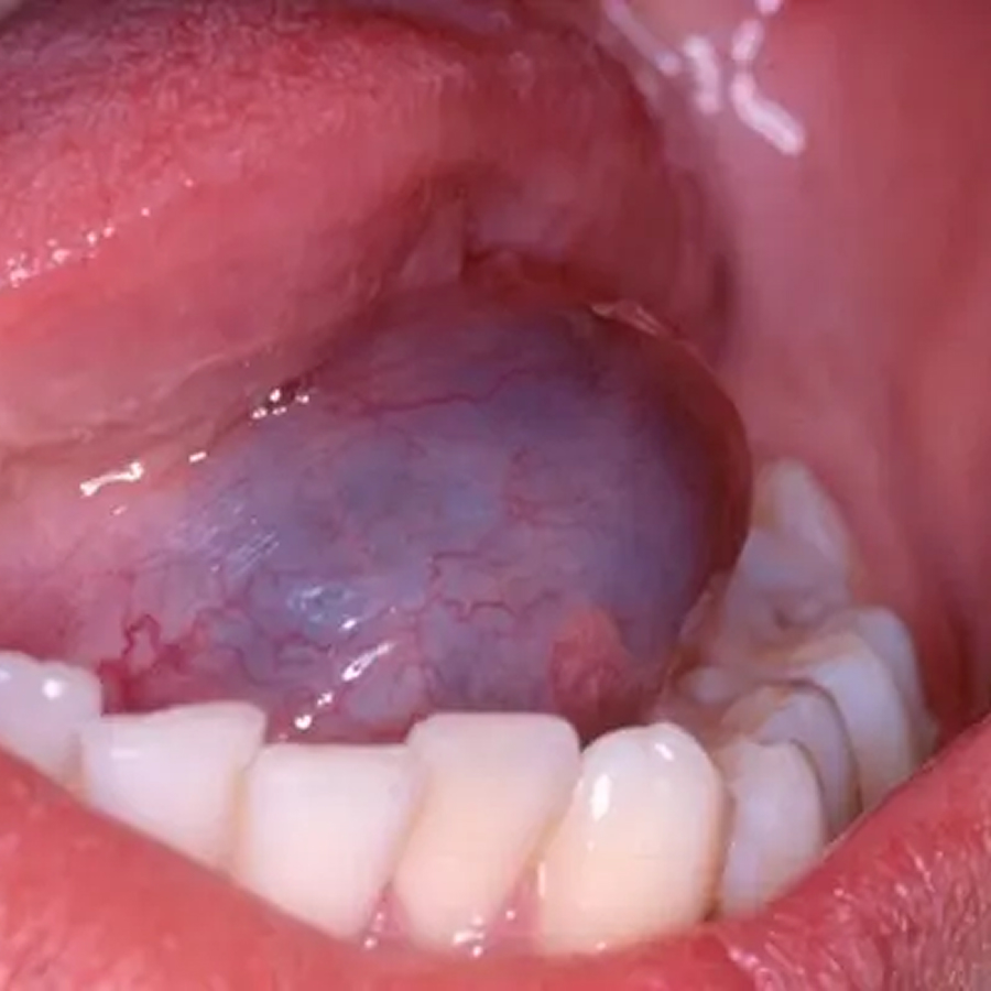 Remoção de Mucoceles