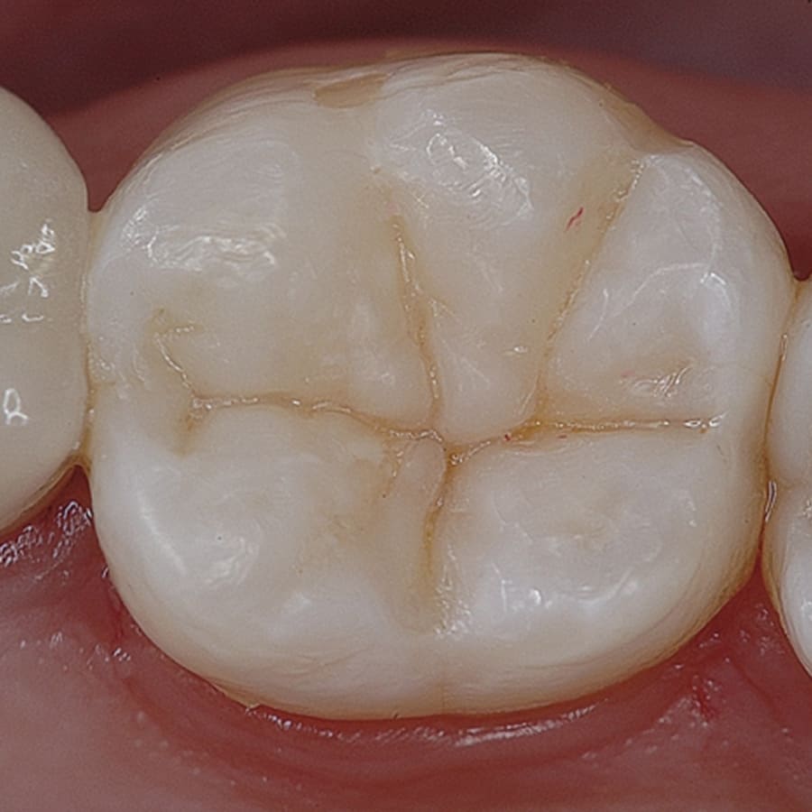 Restauração Dental