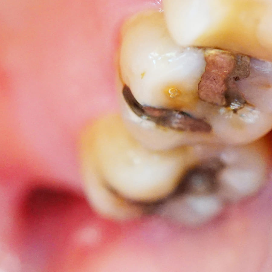 Restauração Dental