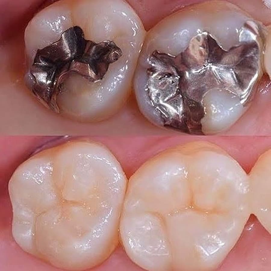 Restauração Dental