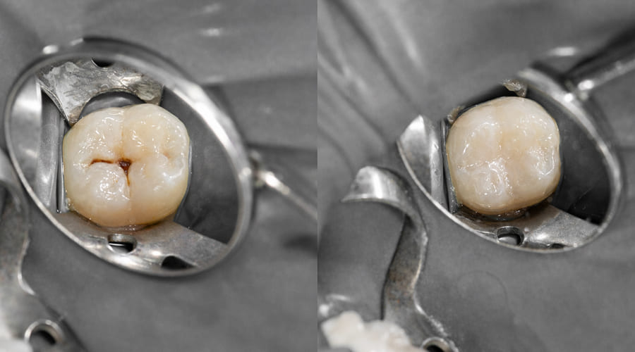 Restauração Dental