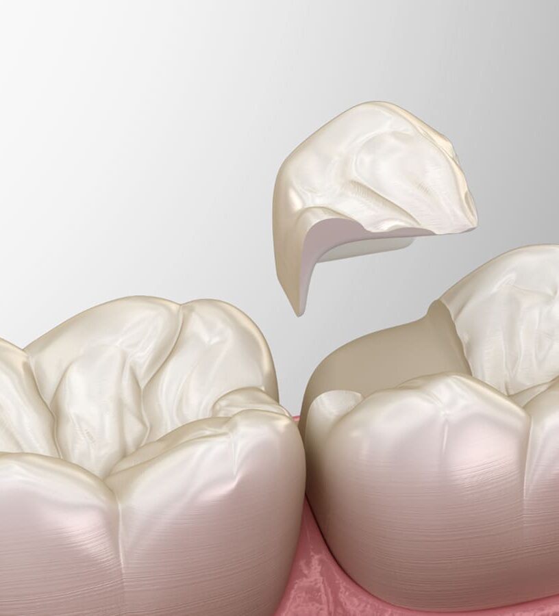 Restauração em Porcelana