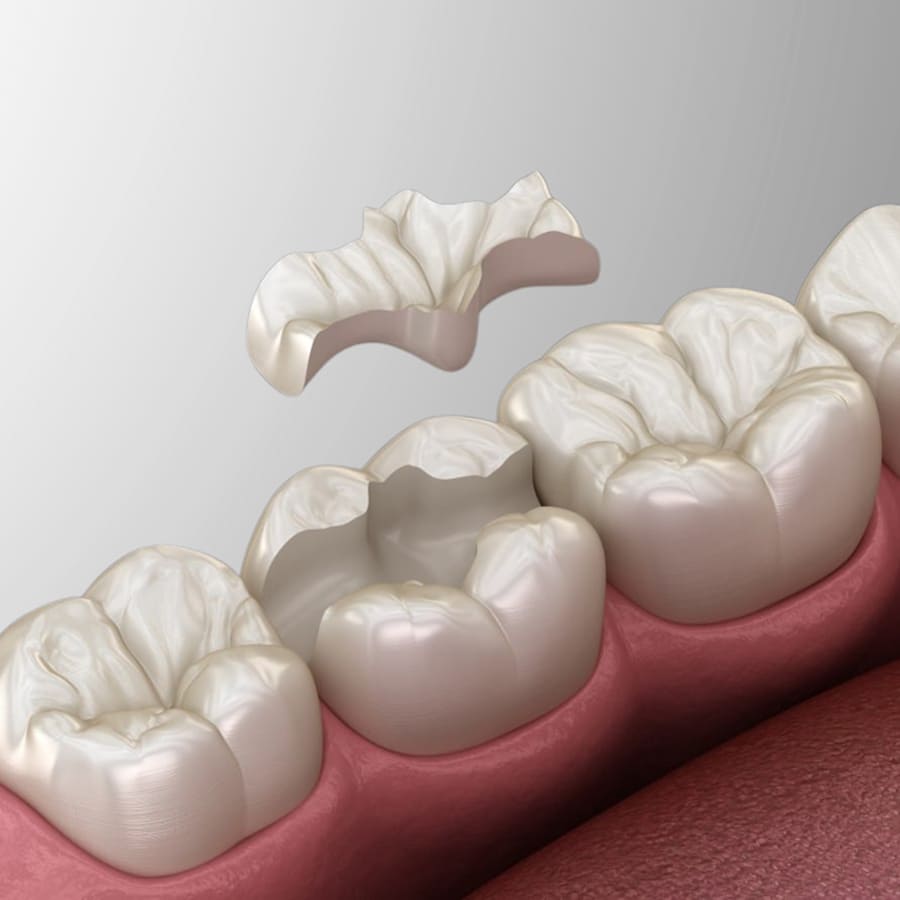 Restauração em Porcelana