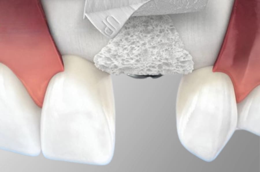 Regeneração Óssea Guiada