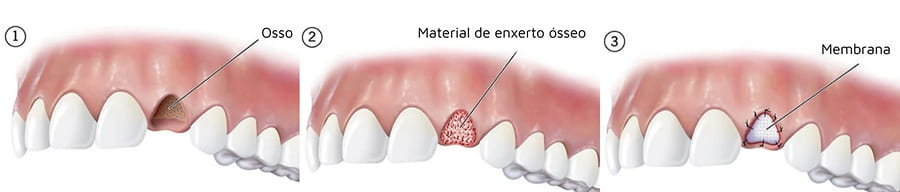 Regeneração Óssea Guiada