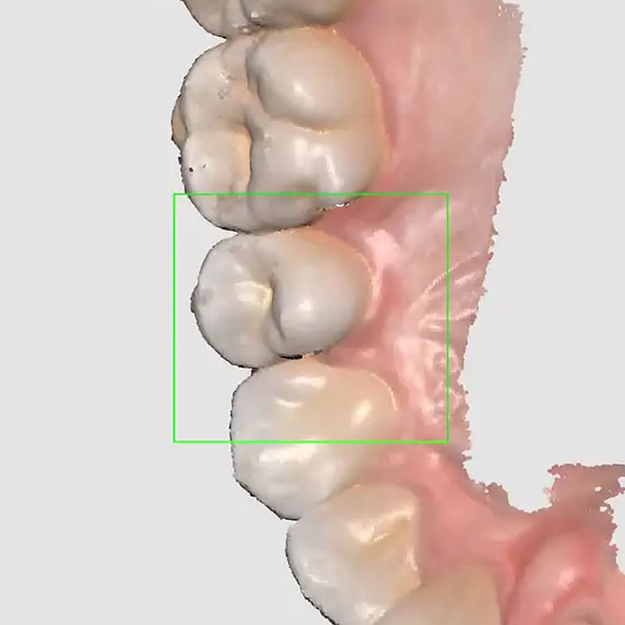 Scanner Intraoral