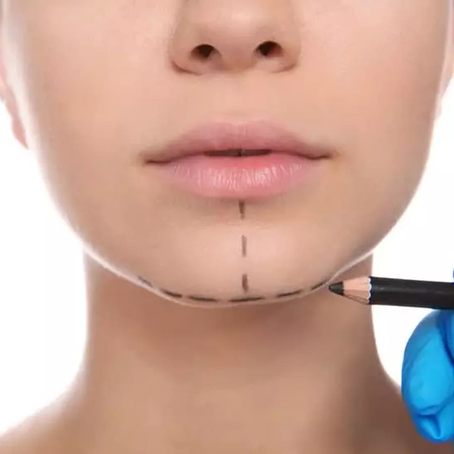 Preenchimento de Queixo