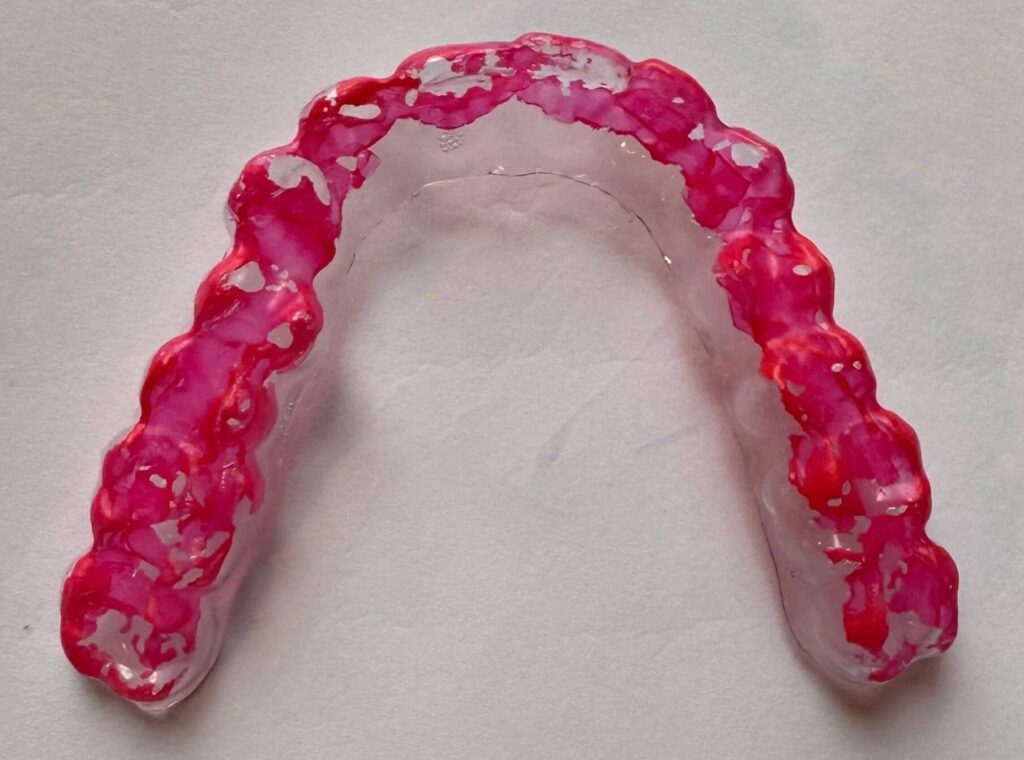 Placa diagnóstica de bruxismo após uso mostrando áreas de contato dentário