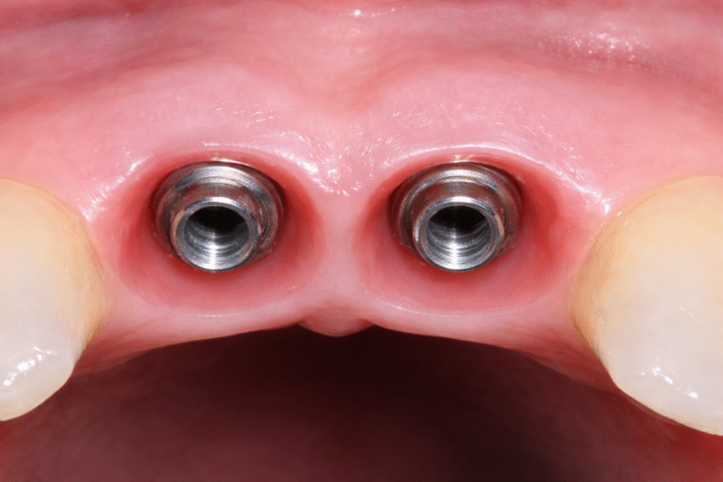 Implantes dentários na região anterior superior com perfil de emergência bem definido, mostrando a transição gradual entre o implante e a gengiva, com contorno gengival moldado, simétrico e aspecto saudável, evidenciando preparo adequado para resultado estético natural.