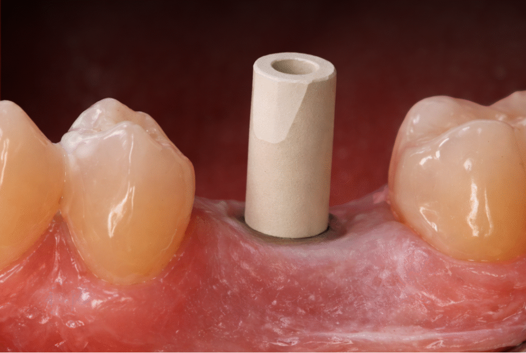 Scanbody instalado sobre implante dentário, utilizado para captura digital da posição do implante com alta precisão.