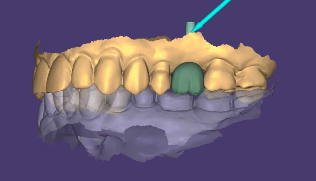 Escaneamento digital da arcada com sobreposição de arquivos, mostrando posição do implante com scanbody e planejamento da coroa em ambiente virtual.