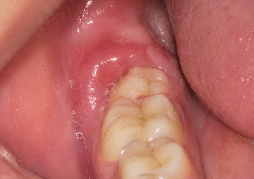 Pericoronarite em siso parcialmente erupcionado com gengiva inflamada na região posterior.