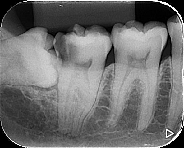 Radiografia mostrando siso mal posicionado associado a cárie no segundo molar adjacente.