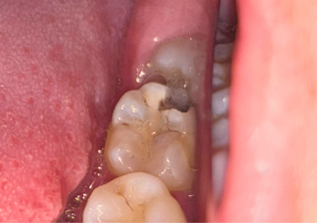 Cárie no segundo molar causada por siso mal posicionado, ilustrando os riscos de não extrair os sisos e a dificuldade de higienização na região posterior