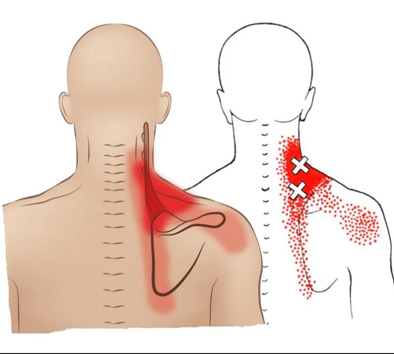 Ilustração mostrando ponto gatilho muscular na região cervical e trapézio, com áreas de dor irradiada para pescoço, ombro e região occipital.