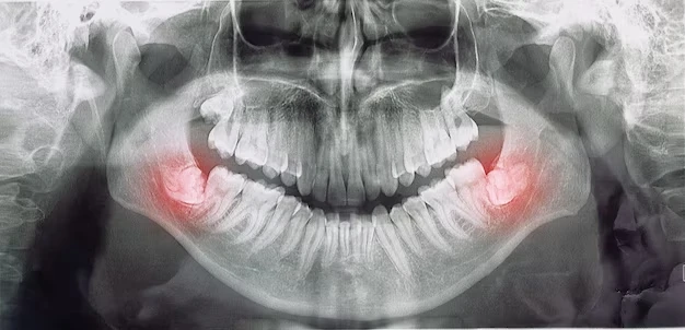 Radiografia panorâmica ilustrando a posição dos sisos.