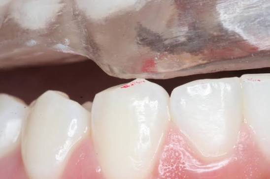 Ajuste oclusal da placa para bruxismo