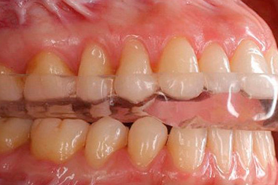 Placa para bruxismo rígida em uso sobre os dentes