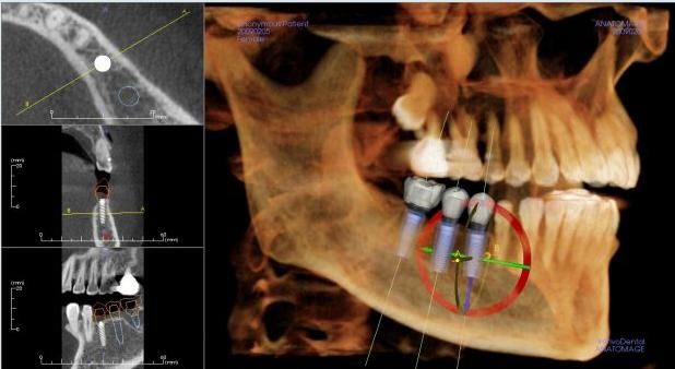 Tomografia computadorizada utilizada no planejamento digital de implante dentário para avaliar a quantidade de osso e definir a posição ideal do implante.