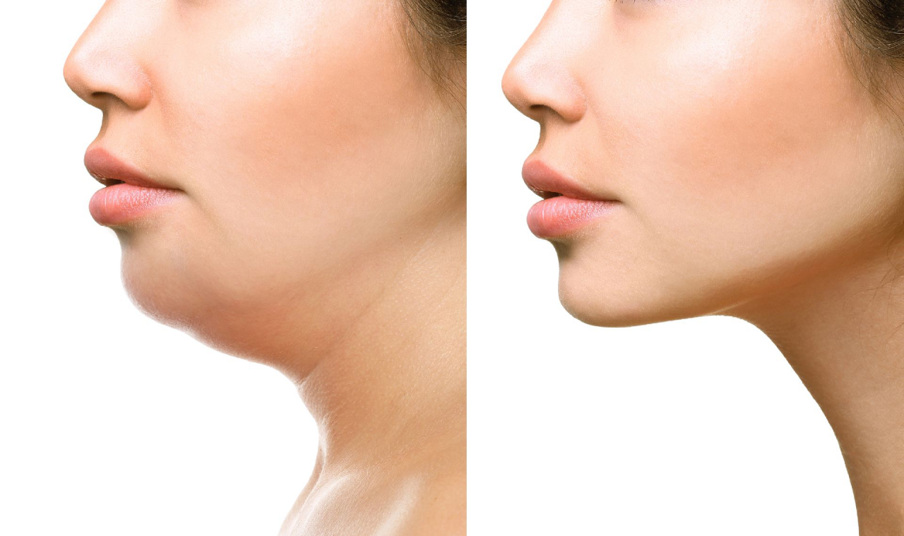 Preenchimento de mandíbula e mento: perfil feminino antes e depois com queixo mais projetado e contorno mandibular definido